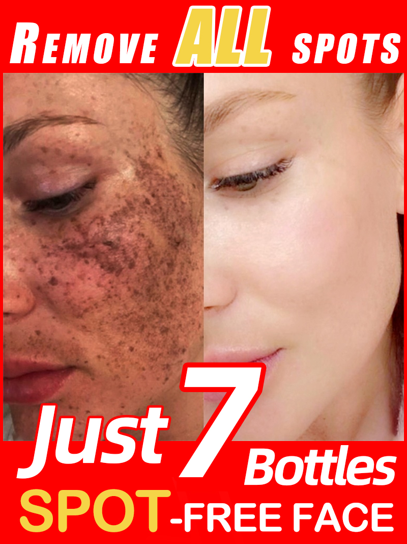 Ultra Luxury Skincare - Çilleri, Melazmayı ve Yüzdeki Koyu Lekeleri